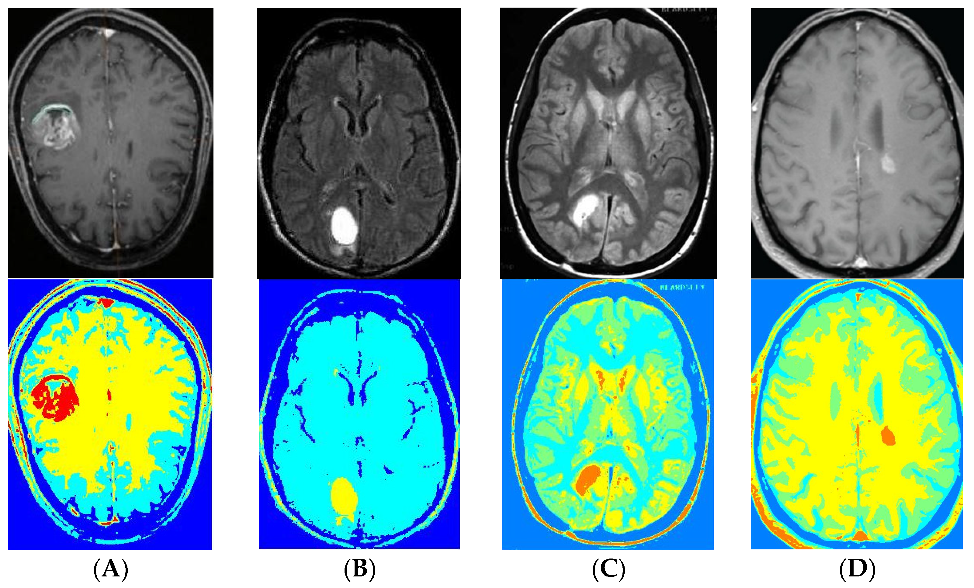 Brain Tumor Detection